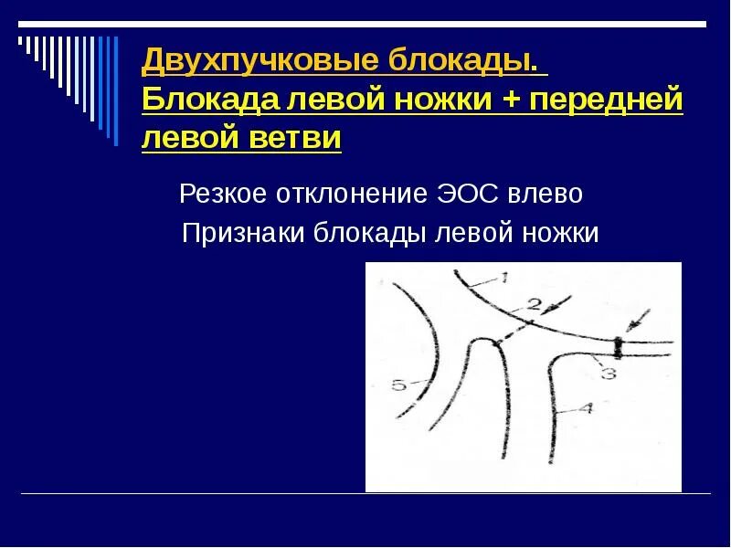 Блокада лнпг на экг. Признаки блокады передней ветви. Миокардит на экг. Блокада передней ветви левой ножки пучка гиса. Блокада задней ветви левой ножки пучка гиса на экг.
