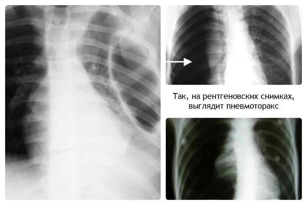 Признаки воздуха в легких. Пневмоторакс с пневмонией на рентгене. Правосторонний пневмоторакс рентген. Пневмоторакс и гидроторакс на рентгене. Клапанный пневмоторакс рентгенограмма.