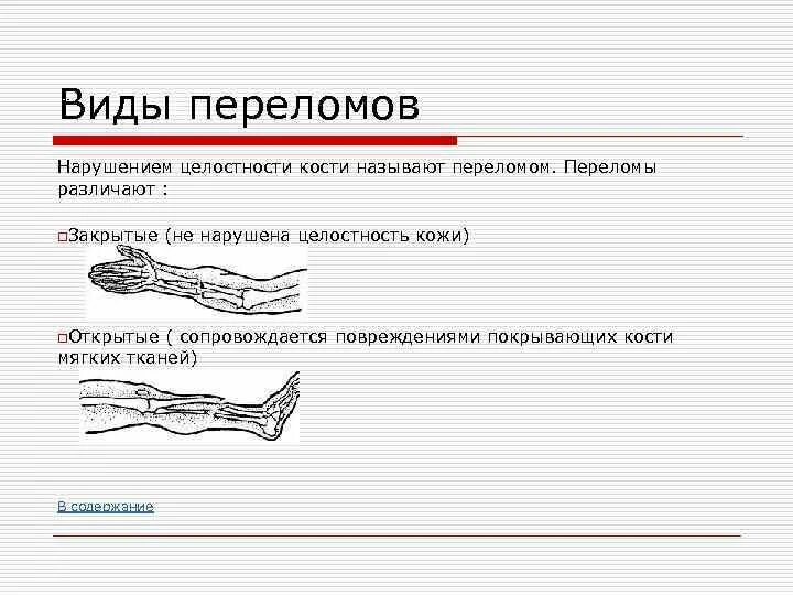 Виды переломов и первая помощь при них. Переломы по степени нарушения целостности кости. Назовите виды переломов перечислите признаки переломов. Перелом — это нарушение целостности кости. Переломы виды переломов первая помощь.