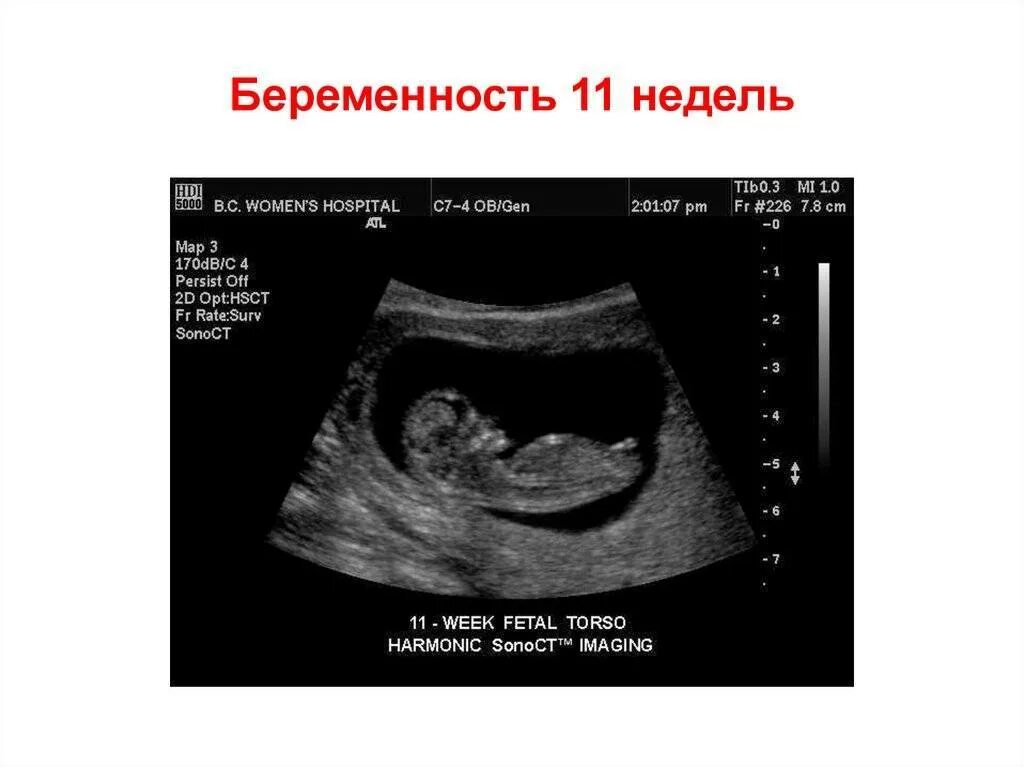 Размер плода акушерских недель. 11 Неделя беременности 11 неделя беременности. Размер эмбриона на 11 неделе беременности. 11 Недель беременности размер.