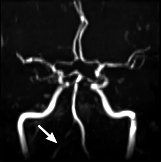 Гипоплазия позвоночной артерии. Гипоплазия позвоночной артерии мрт. Аплазия позвоночной артерии мрт. Гипоплазия правой позвоночной артерии на кт. Гипоплазия правой артерии головного мозга