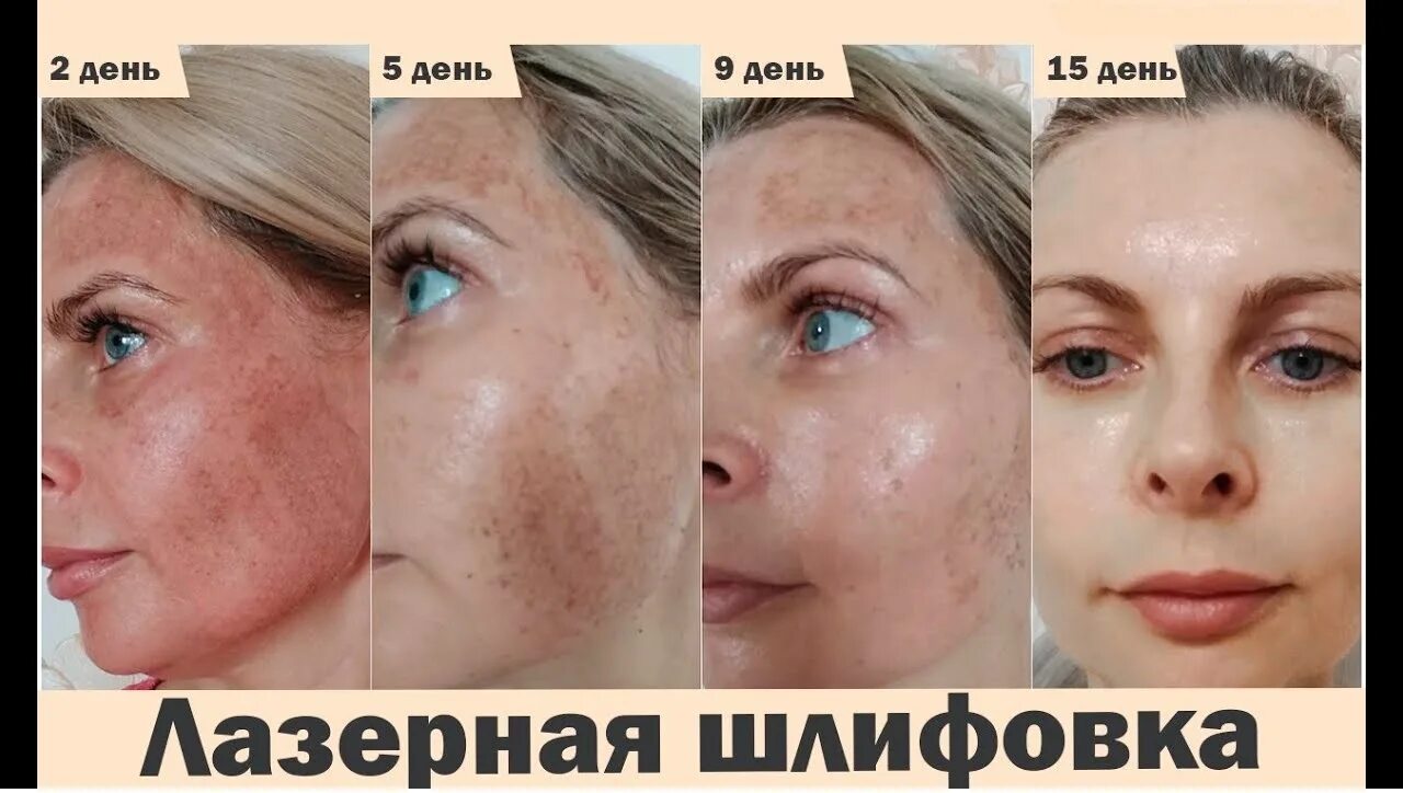 Через сколько восстанавливается кожа