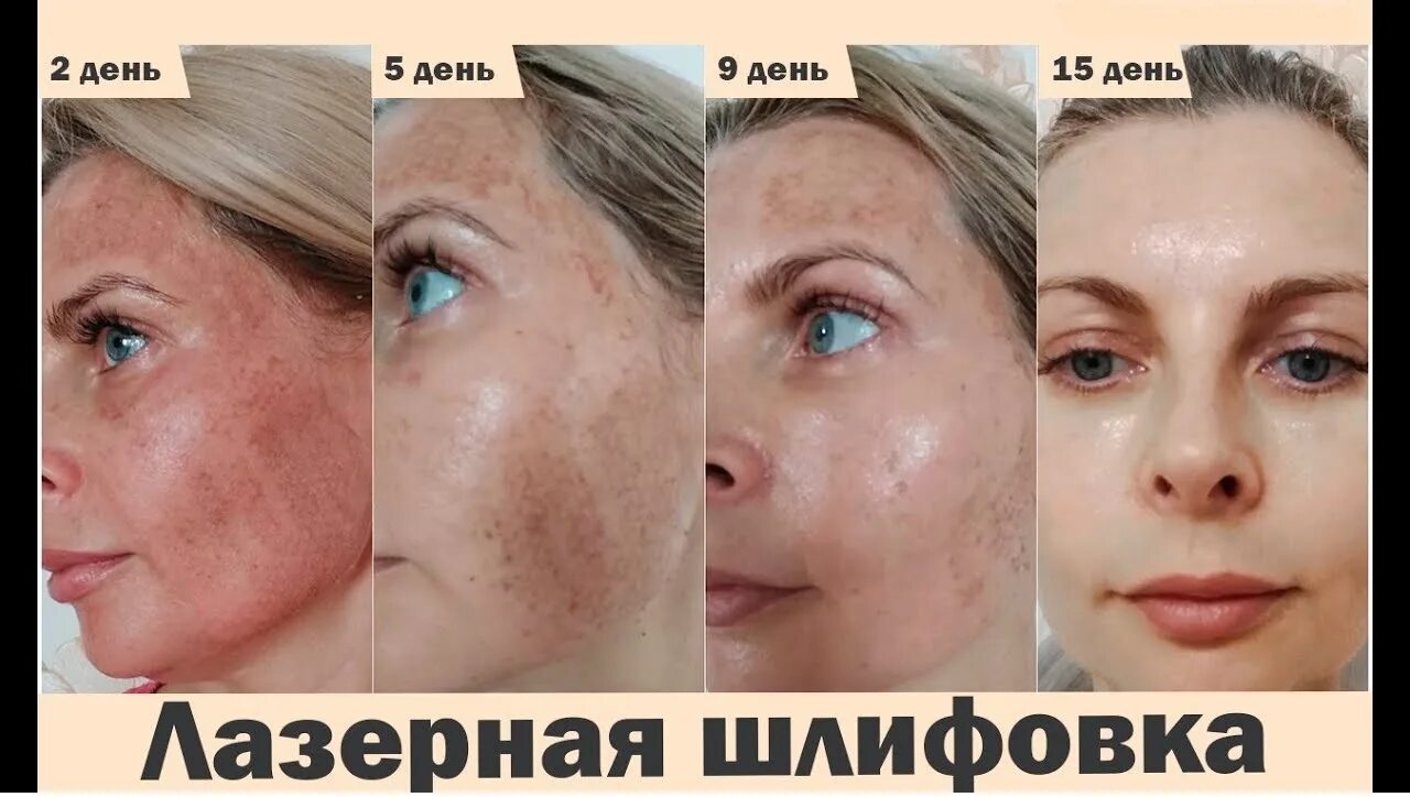 Лазерная шлифовка кожи цена skinlift ru. Лазерная шлифовка (со2 лазер). Фракционная шлифовка со2 лазером. Фракционная лазерная шлифовка со2. Fraxini фракционный лазер со2.