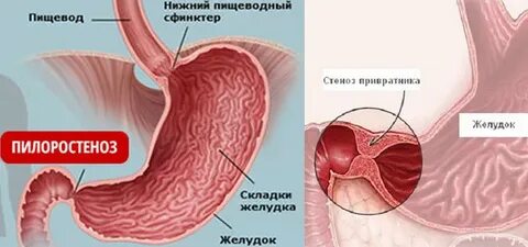Рубцовая деформация привратника