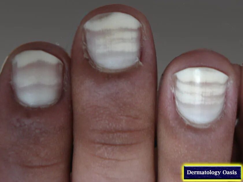 Почему белеют ногти. Нормотрофический онихомикоз. Негрибковые заболевания ногтей. Ониходистрофия (дистрофия ногтей). Почему белеют ногти.