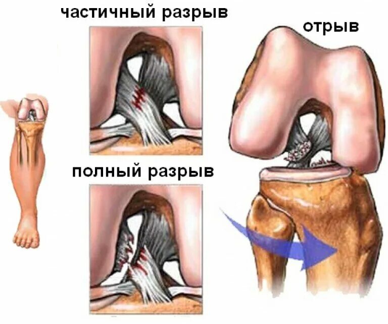 Крестовидная коленная связка. Классификация разрывов крестообразной связки. Отрыв крестообразной связки колена. Повреждение ПКС коленного сустава. Передняя крестообразная связка коленного сустава разрыв.