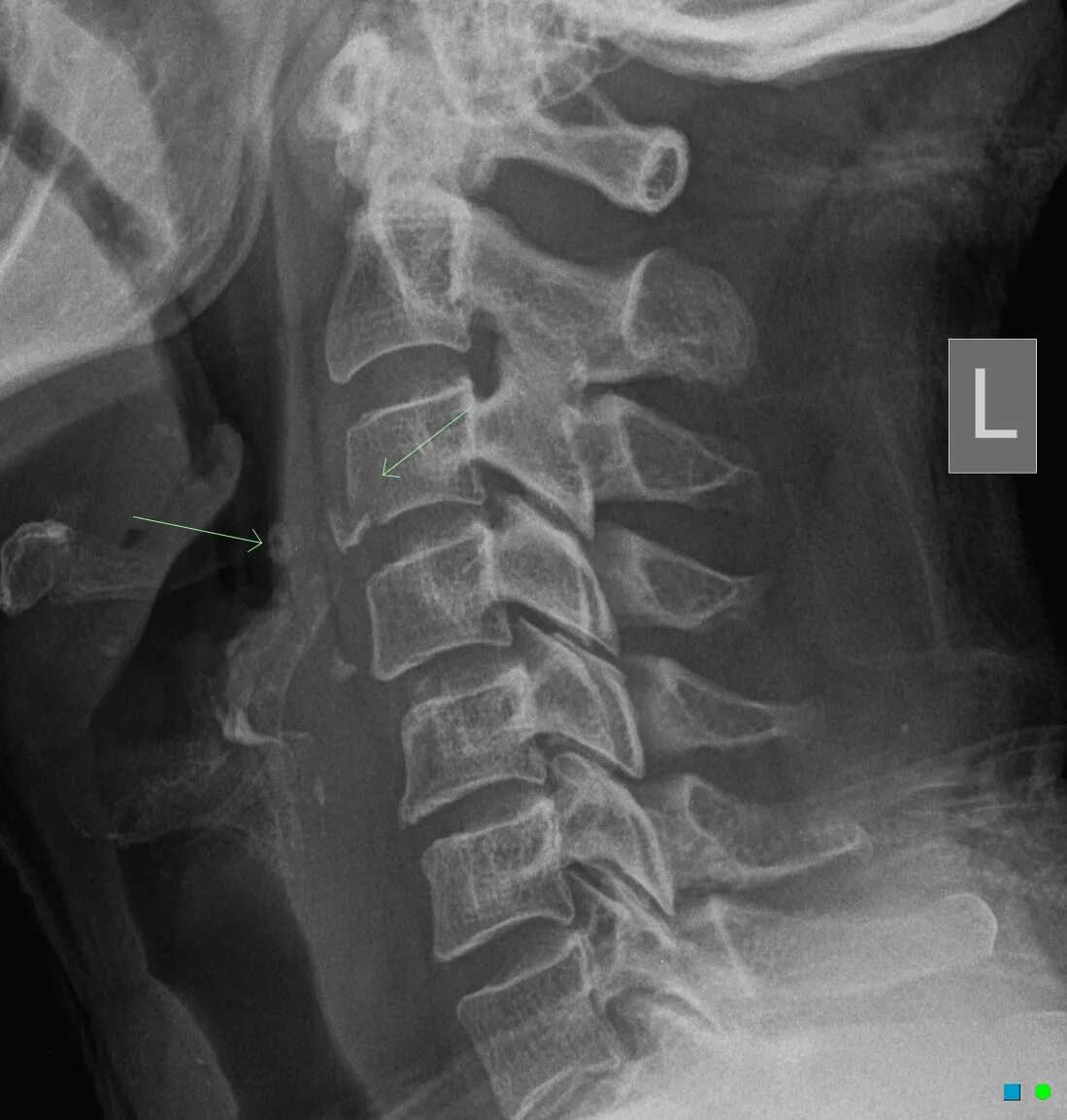 Spine x-ray. X-ray Spinal Fracture. Flexion Teardrop Fracture. Teardrop Extension Fracture. Xray extension