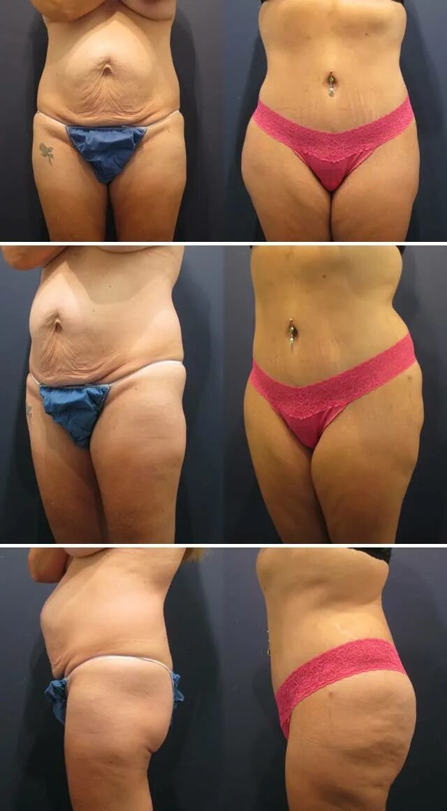 Липосакция липоскульптура. Липосакция живота результат. Отзывы после липосакции живота. Операция абдоминопластика живота. Отзывы после липосакции живота.