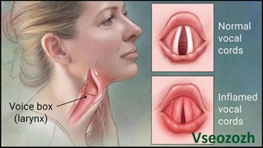Лечение голосовых связок. Хронический узелковый ларингит. Воспаленные голосовые связки.