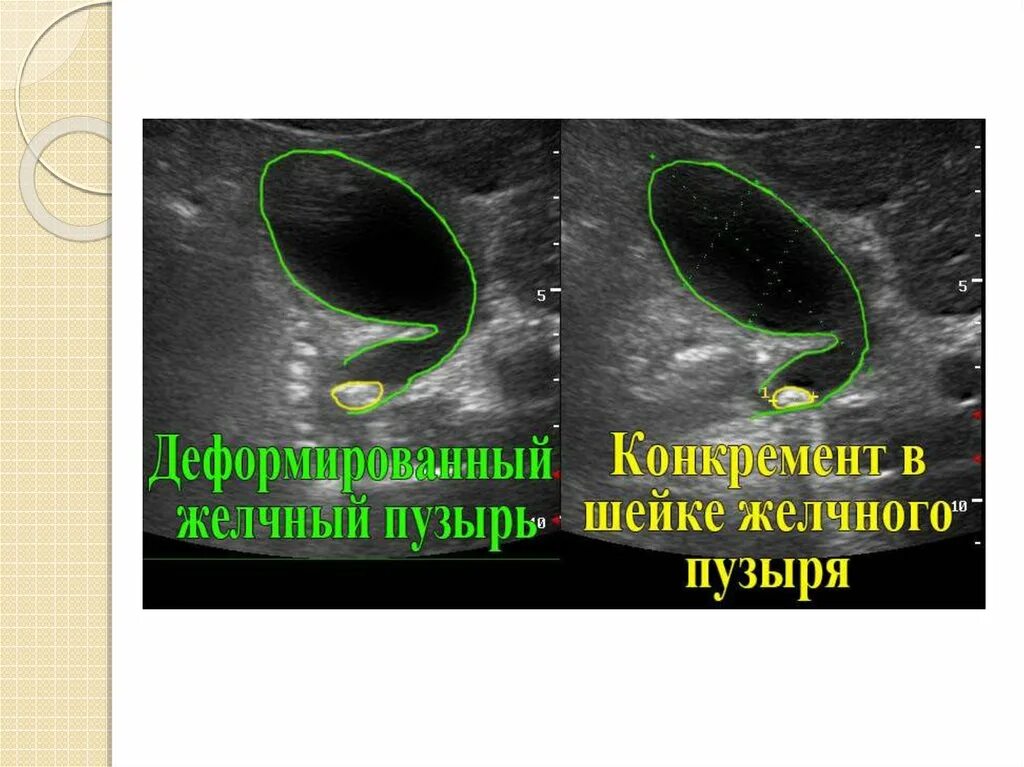 Перегиб желчного пузыря что делать. S образный желчный пузырь УЗИ. Деформированный желчный пузырь. S образный загиб желчного пузыря. Деформирование желчного пузыря.