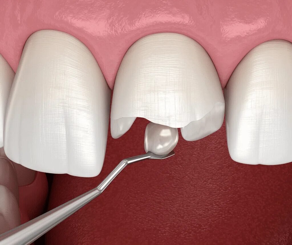 Материал для реставрации зубов. Композитные виниры Эстелайт. Художественное восстановление зубов.