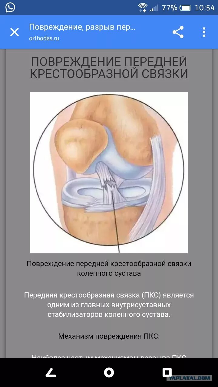 Артроскопия пластика крестообразной связки ПКС коленного сустава. Разрыв мениска артроскопия. ПКС (передняя крестообразная связка). Разрыв связок коленного сустава ПКС операция.