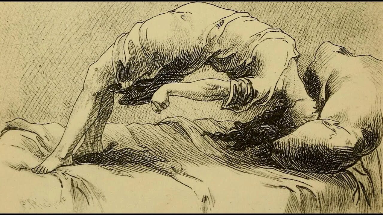 Epilepsia на руси называлась падучая немочь. День больных эпилепсией. Epilepsia на руси называлась падучая немочь. Эпилепсия у детей симптомы. Epilepsia на руси называлась падучая немочь.