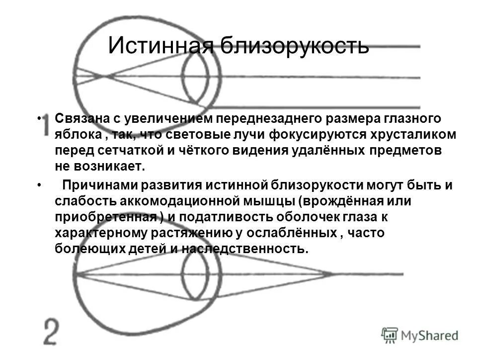 Истинная близорукость. Истинная миопия. Ложная и истинная близорукость. Развитие близорукости.