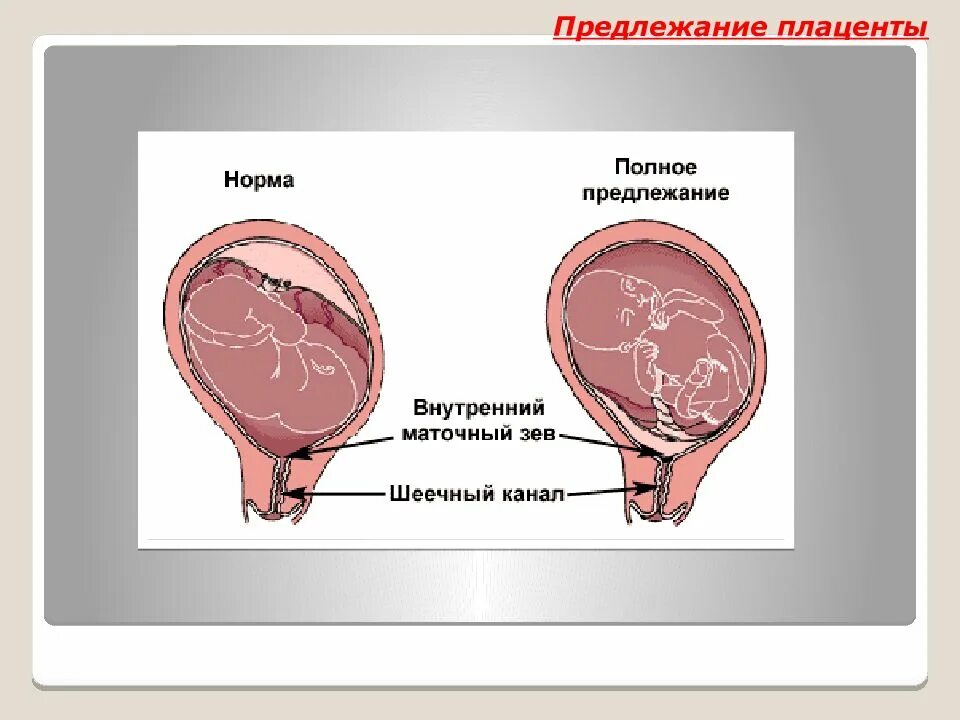 Плацента перекрывает область внутреннего зева. Плацента краевое предлежание плаценты. шеечное предлежание плаценты. краевое и центральное предлежание плаценты. предлежание плаценты боковое центральное.