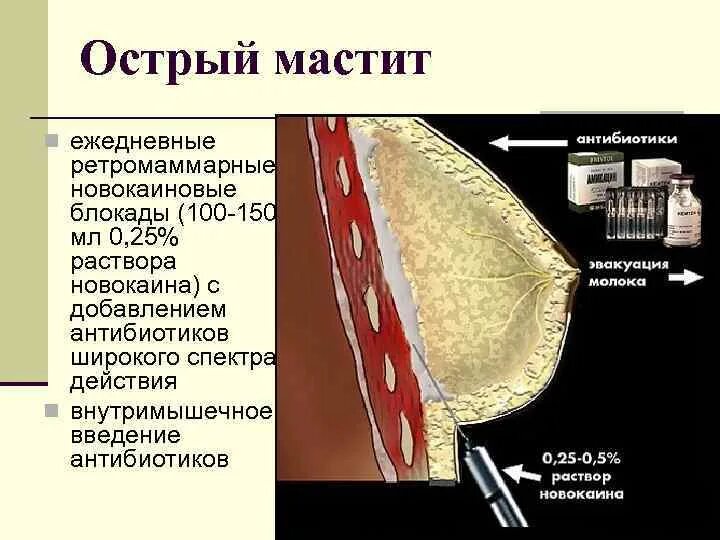 Ретромаммарная блокада. Ретромаммарная новокаиновая блокада. Ретромаммарное пространство. Острый гнойный мастит