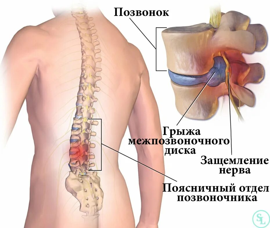 Боли в пояснице название. Межпозвонковые диски c5 c6 c7. Междисковая грыжа позвоночника. Межпозвоночная грыжа грыжа поясничного отдела. Межпозвоночные диски l2-l3 почки.