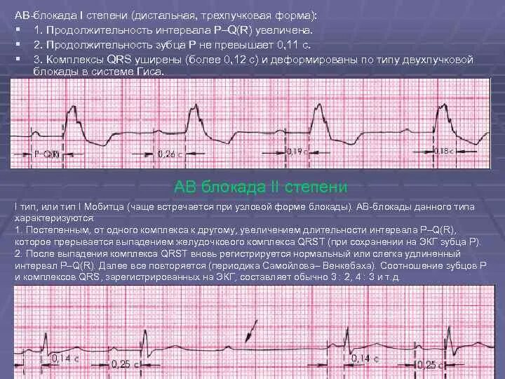 Системами блокада. Атриовентрикулярная блокада 1 степени на ЭКГ. ЧСС при АВ блокаде 1 степени. АВ блокада 1 степени на ЭКГ. АВ блокада 2 степени PQ.