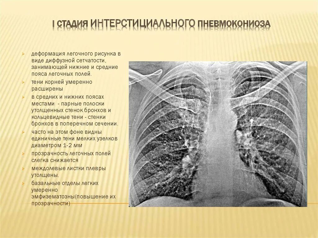 Пневмокониоз 1 стадия рентген. Пневмокониоз легких 1 стадия рентген. Пневмокониоз интерстициальная форма рентген. Стадии пневмокониоза рентген.