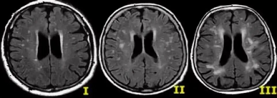 Лейкоареоз Фазекас. Очаги Фазекас мрт. Fazekas 2. Перивентрикулярный глиоз на мрт. Единичные очаги в белом веществе сосудистого генеза