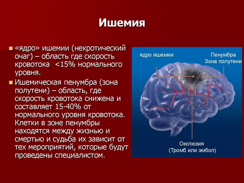 Области ишемии