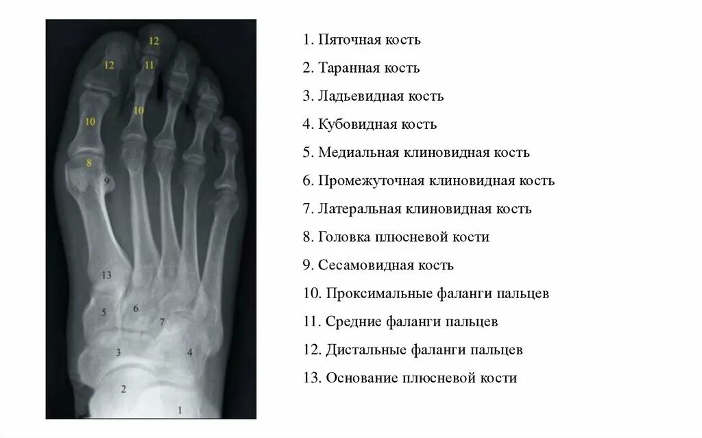 Кости 1 пальца стопы анатомия. Медиальная клиновидная кость стопы анатомия. Проксимальная фаланга пальца стопы анатомия. Медиальная клиновидная кость стопы. Кости стопы вид сбоку анатомия.