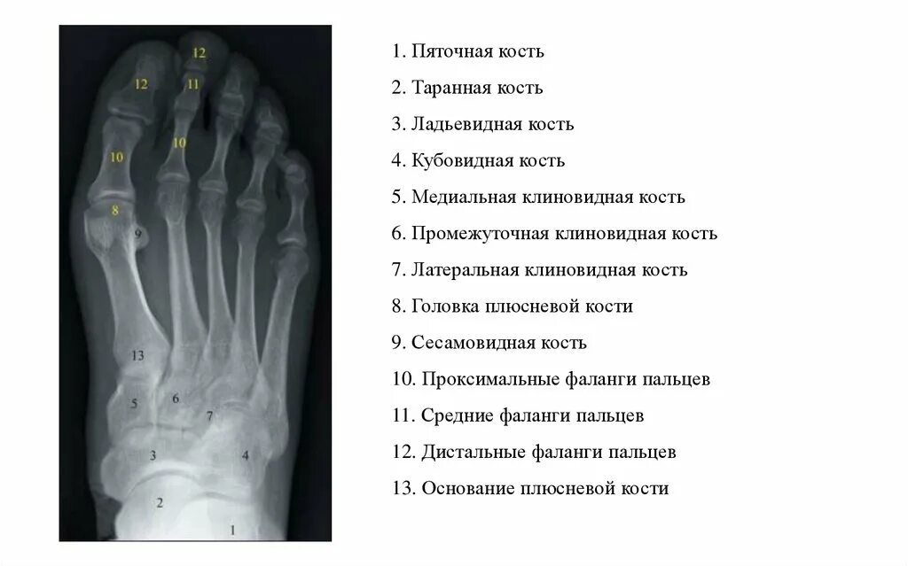 5 фаланга стопы. Анатомия дистальной фаланги пальца стопы. Сесамовидная кость ладьевидной кости стопы рентген. Кубовидная кость стопы рентген. Перелом головки плюсневой кости стопы рентген.