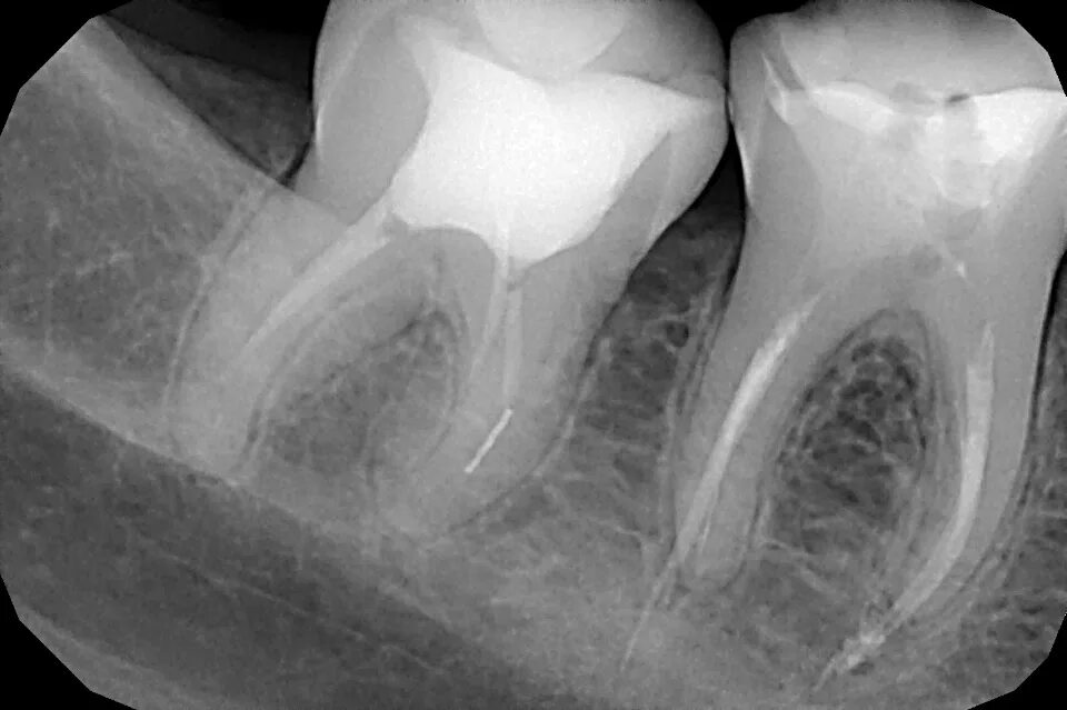 Восстановление после эндодонтического лечения. Перфорация корневого канала рентген. Перфорация корня зуба на рентгене. Отлом эндодонтического инструмента в канале корня.