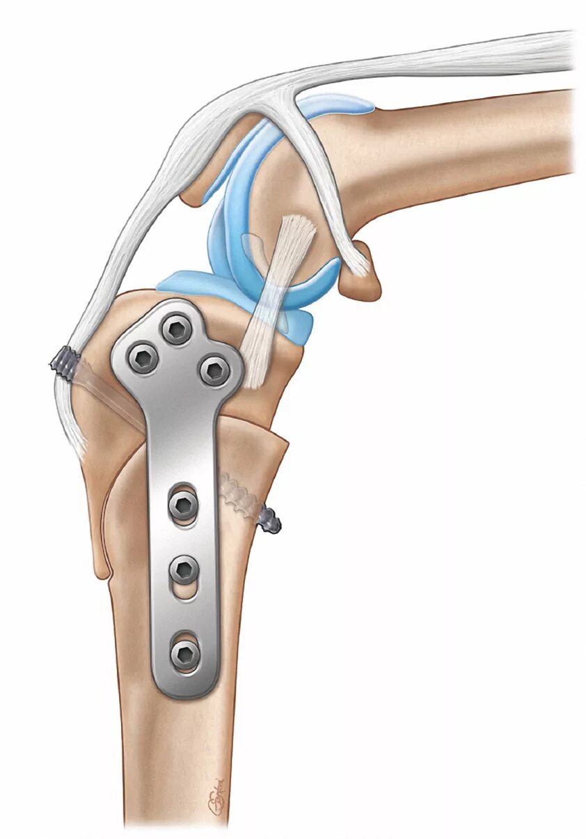 Крестовидная коленная связка. Метод TPLO при разрыве связок. ПКС У собаки операция TPLO.