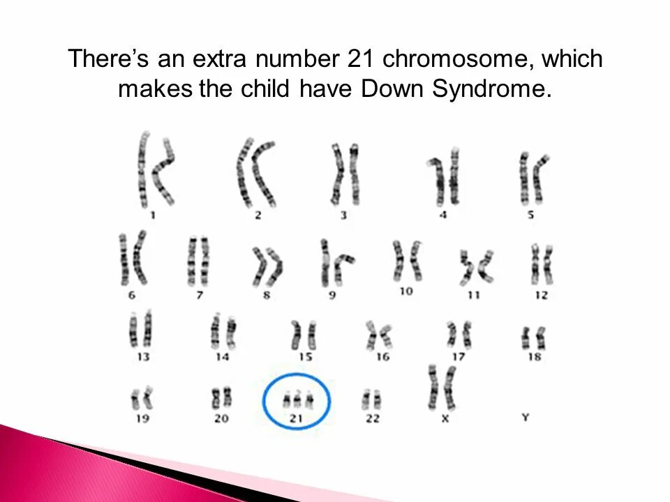 Синдром Дауна хромосомы. Трисомия по 21 хромосоме. Хромосомы человека с синдромом Дауна. Синдром Дауна трисомия. Лишняя 21 хромосома