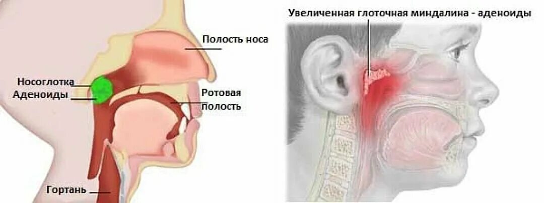 Болит носоглотка что делать. Гиперплазия глоточной миндалины. Анатомия ЛОР органов аденоиды. Глоточная миндалина аденоиды. Строение носоглотки аденоиды.