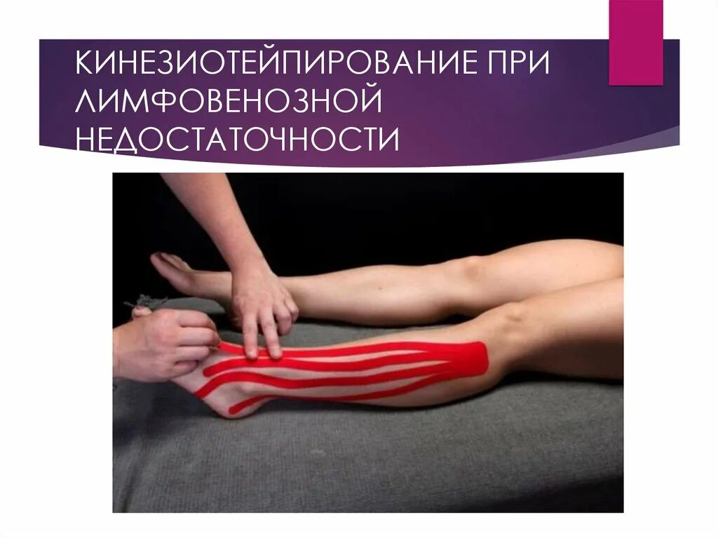 Edema кинезио bb edema strip мах 5cм*25см (бежевый). Наложение тейпа на стопу. Лимфодренажное тейпирование икры. Клапаны вен нижних конечностей анатомия. Упражнения для профилактики варикоза.