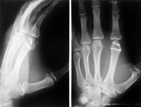 Перелом головки кисти. Перелом эпифиза пястной кости. Перелом 2 пястной кости. Перелом головки кисти. Перелом головки кисти.