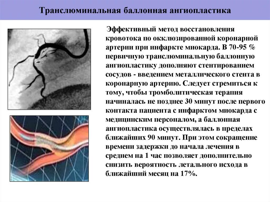 Баллонная коронарная ангиопластика. ТРАНСЛЮМИНАЛЬНАЯ ангиопластика сосудов. Чрескожная ТРАНСЛЮМИНАЛЬНАЯ коронарная ангиопластика. Баллонная дилатация (баллонная ангиопластика). Эндоваскулярная баллонная ангиопластика.