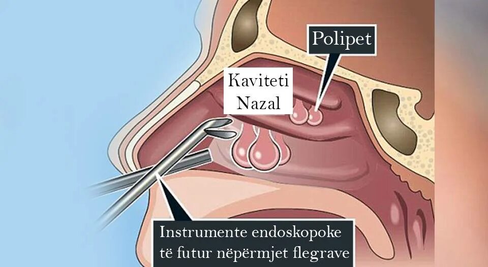 Операция полипы сколько стоит. Эндоскопическая шейверная полипотомия. Полипы околоносовых пазух.