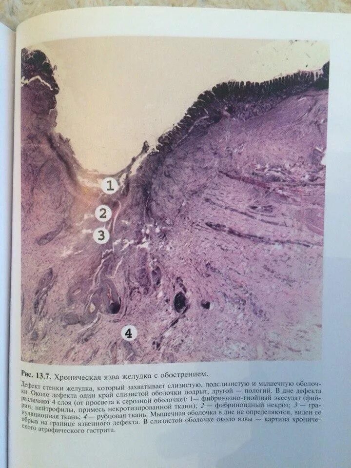 Хроническая язва желудка макропрепарат. Хроническая язва желудка макропеепараь. Острая язва желудка макропрепарат патанатомия. Хроническая язва желудка гистология препарат.