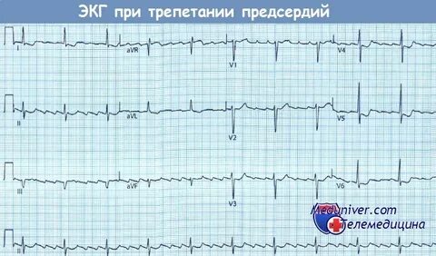Синдром вольфа паркинсона уайта