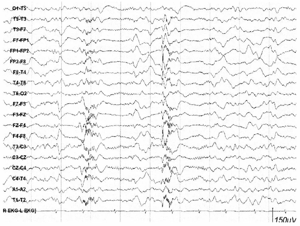 Эпилептиформная активность на ЭЭГ. Спайки на ЭЭГ. Спайк волна на ЭЭГ. Эпилептиформные разряды на ЭЭГ. Спайк на ээг