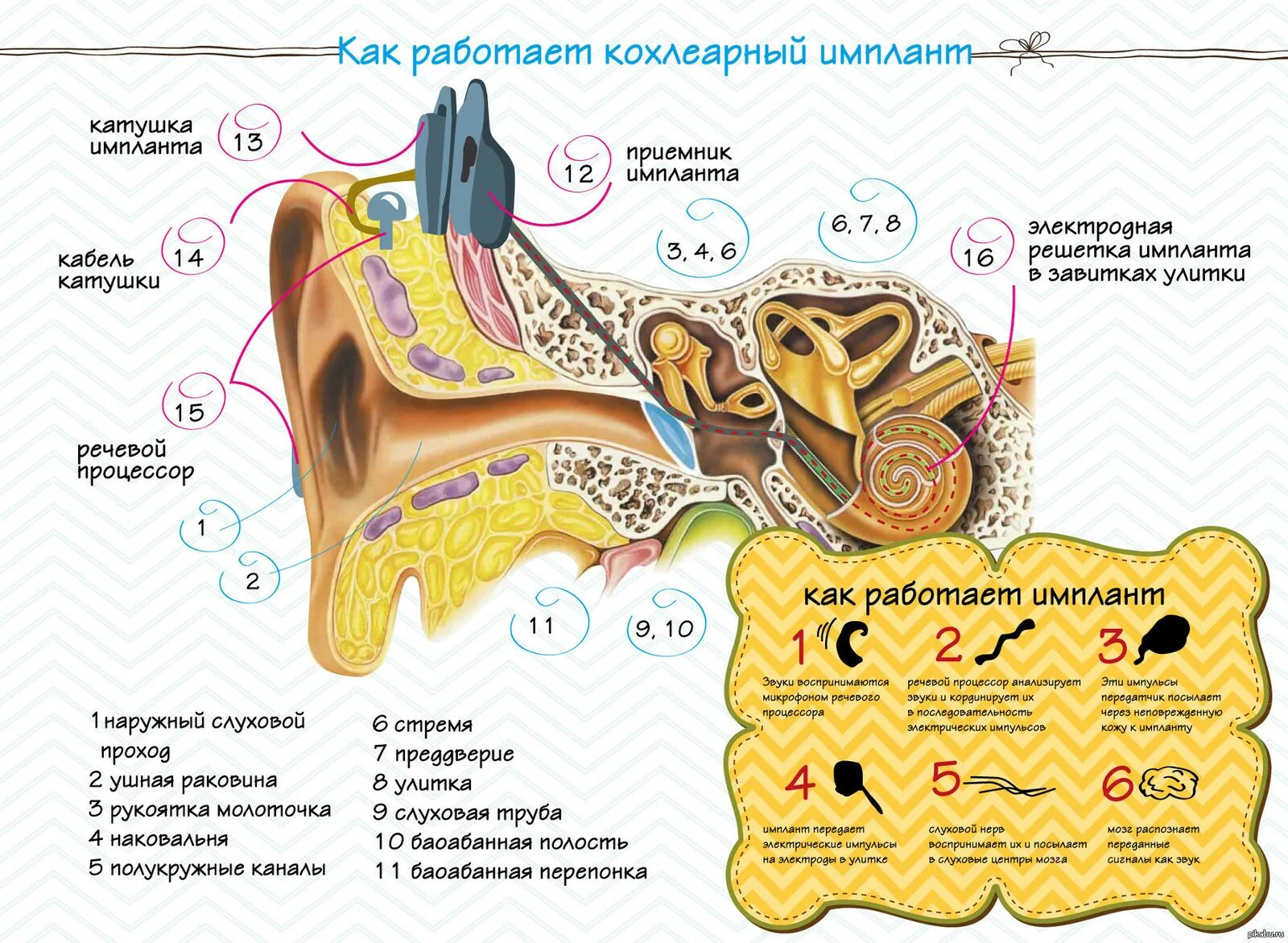 Кохлеарная имплантация строение уха. Слуховой аппарат кохлеарный имплант. Кохлеарная имплантация строение. Кохлеарный имплантат из чего состоит. Операция на ухо на слух