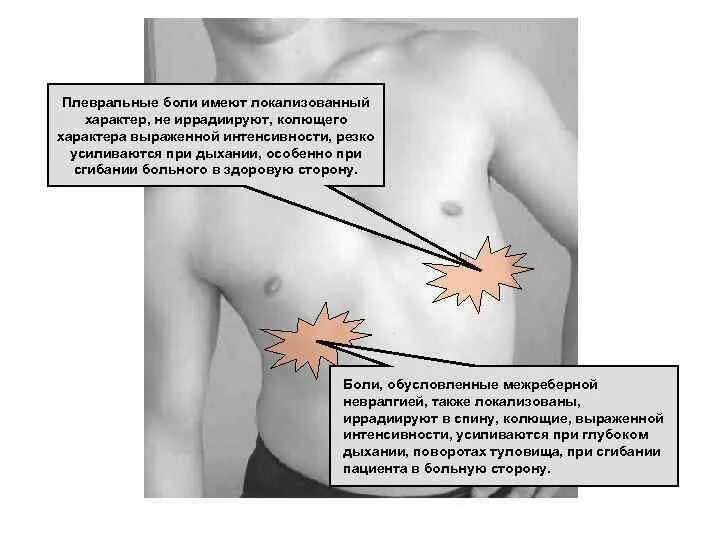 Межреберная невралгия симптомы. Межрёберная невралгия слева. Боли при межреберной невралгии. Межреберная неврология симтомы.