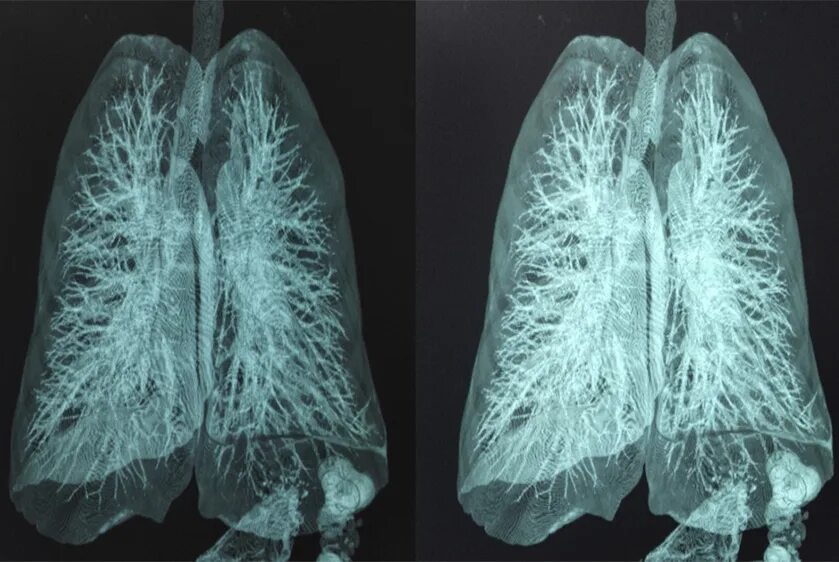 Компьютерная томография легких. Кт легких. Снимок кт легких. Здоровые легкие снимок кт.