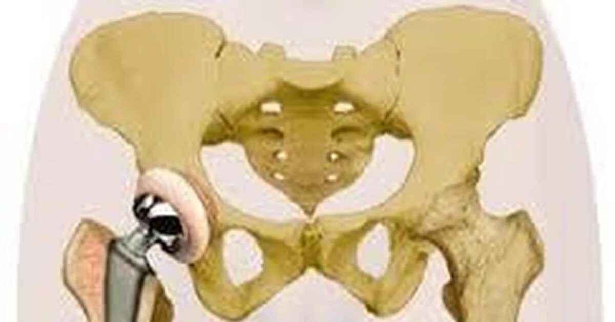 Операция тазобедренный кость. Перелом шейки бедра эндопротезирование. Перелом шейки бедра эндопротезирование тазобедренного сустава. Перелом шейки бедра операция эндопротез. Эндопротез тазобедренного сустава перелом шейка.