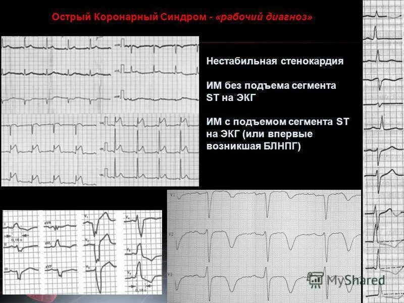 Экг подъем