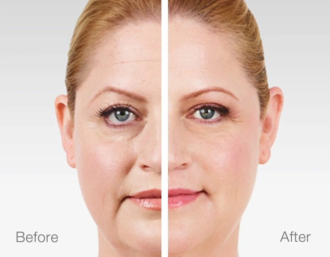 Биоревитализация lj b gjckt. Вокруг глаз носогубные складки. Морщины до после. Схема инъекций гиалуроновой кислоты. Кислоты убирающие морщины.