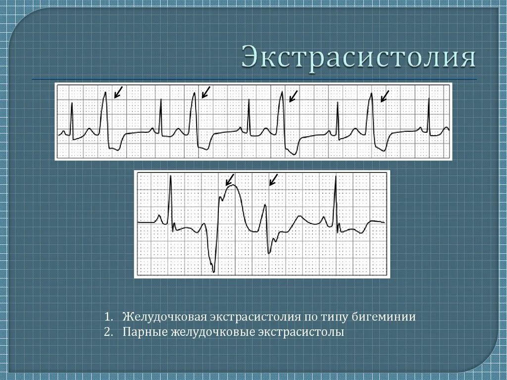 Типы экстрасистол