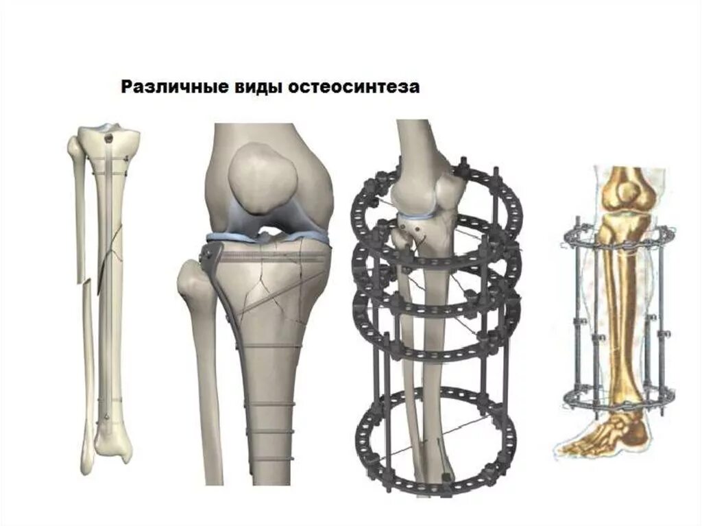 Лечение после переломов костей. Перелом большеберцовой кости остеосинтез. Внутрикостный остеосинтез большеберцовой кости. Перелом бедра остеосинтез. Остеосинтез перелома берцовой кости.