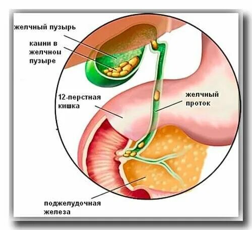 Как почистить желчный проток. Удаленный желчный пузырь.