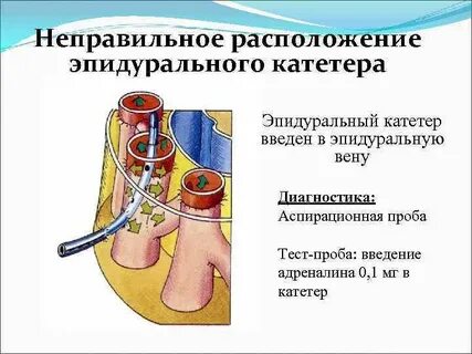 Постановка катетера манипуляция