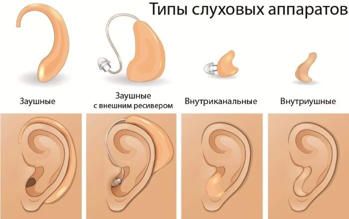 Слуховые аппараты бывают. Слуховой аппарат. Виды слуховых аппаратов. Аналоговый слуховой аппарат заушный. Разные типы слуховых аппаратов.