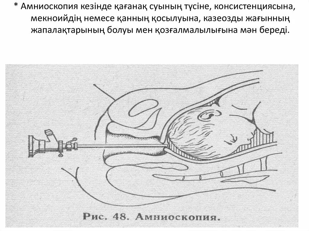 Амниоскопия и амниоцентез. Амниоскопия при беременности алгоритм. Амниоскопия техника выполнения.